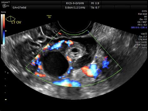 diagnostic test for ovarian torsion|ovarian torsion vs ectopic pregnancy.